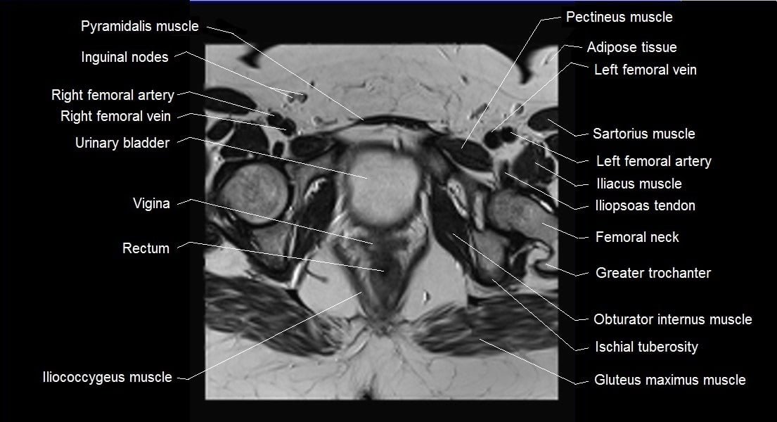 female pelvis anatomy axial image 23