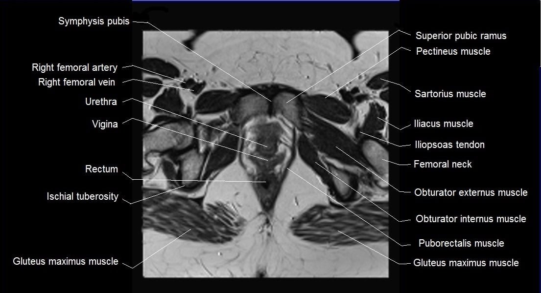 female pelvis anatomy axial image 25