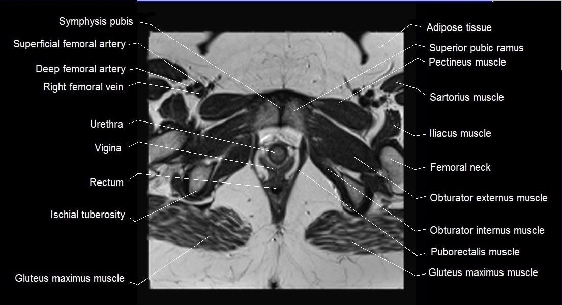 female pelvis anatomy axial image 26