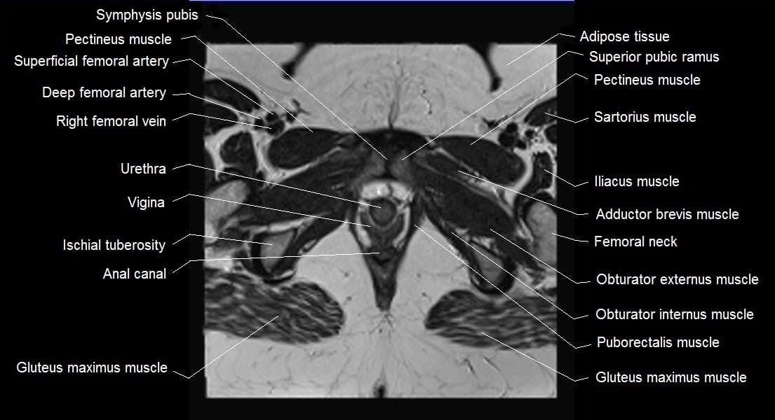 female pelvis anatomy axial image 27