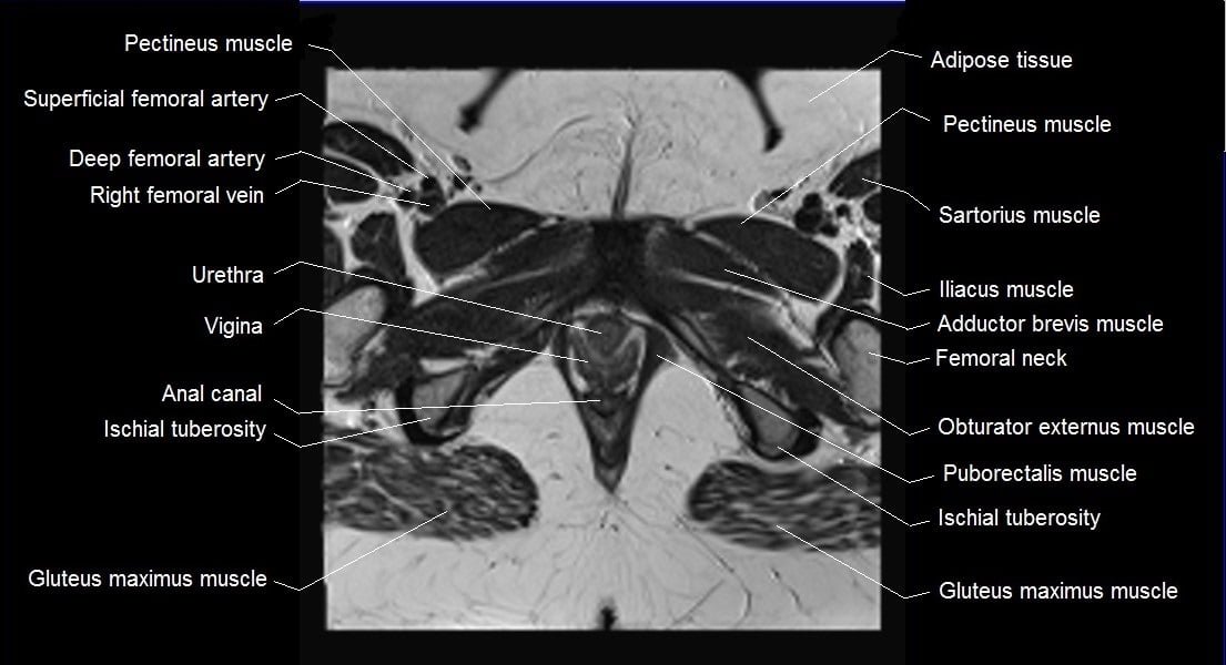 female pelvis anatomy axial image 28