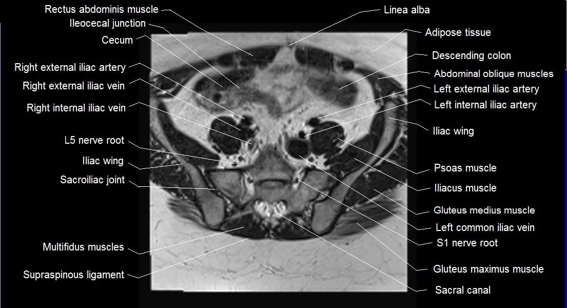 mri female pelvis anatomy axial image 3