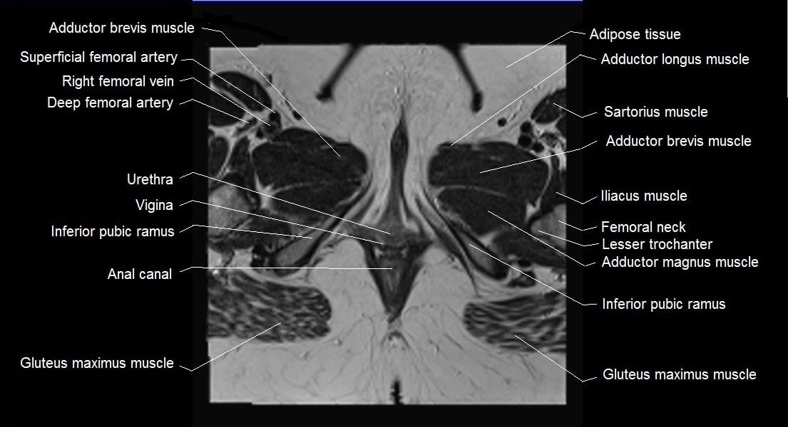 female pelvis anatomy axial image 31