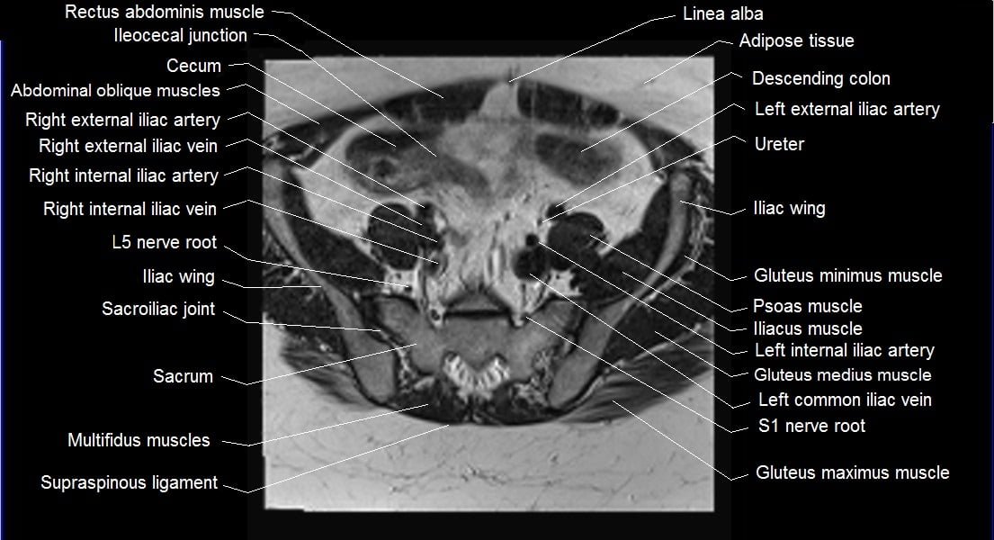 mri female pelvis anatomy axial image 4