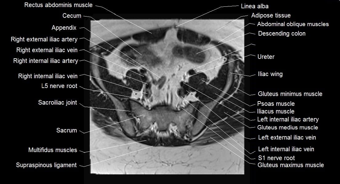 mri female pelvis anatomy axial image 5