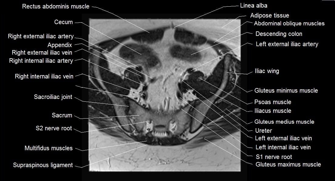 mri female pelvis anatomy axial image 6