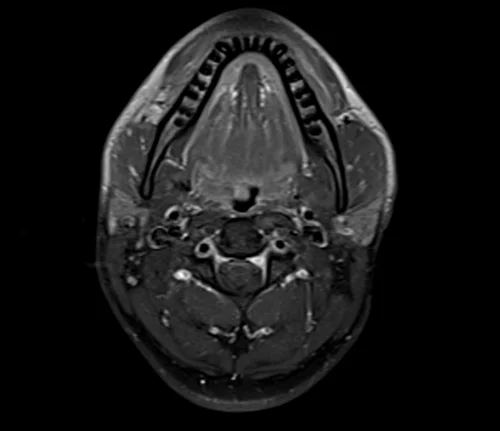 neck axial t1 fat sat post contrast image 2