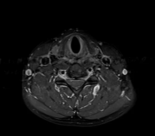 neck axial t1 fat sat post contrast image 3