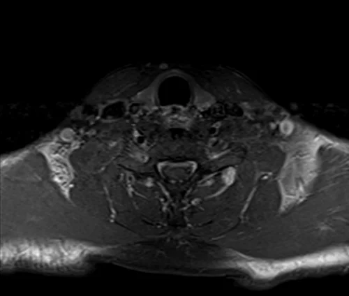 neck axial t1 fat sat post contrast image 4