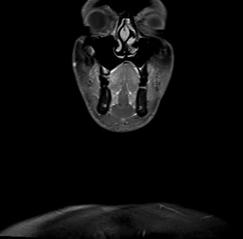 neck coronal t1 fat sat post contrast image 1