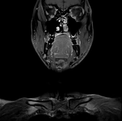 neck coronal t1 fat sat post contrast image 2