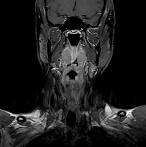 neck coronal t1 fat sat post contrast image 3