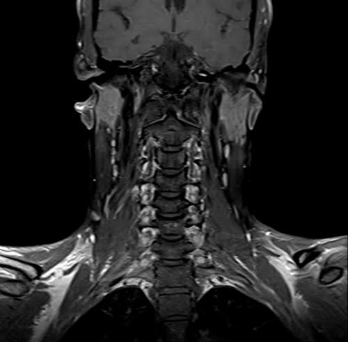 MRI Soft tissue neck coronal T1 fat sat post contrast images