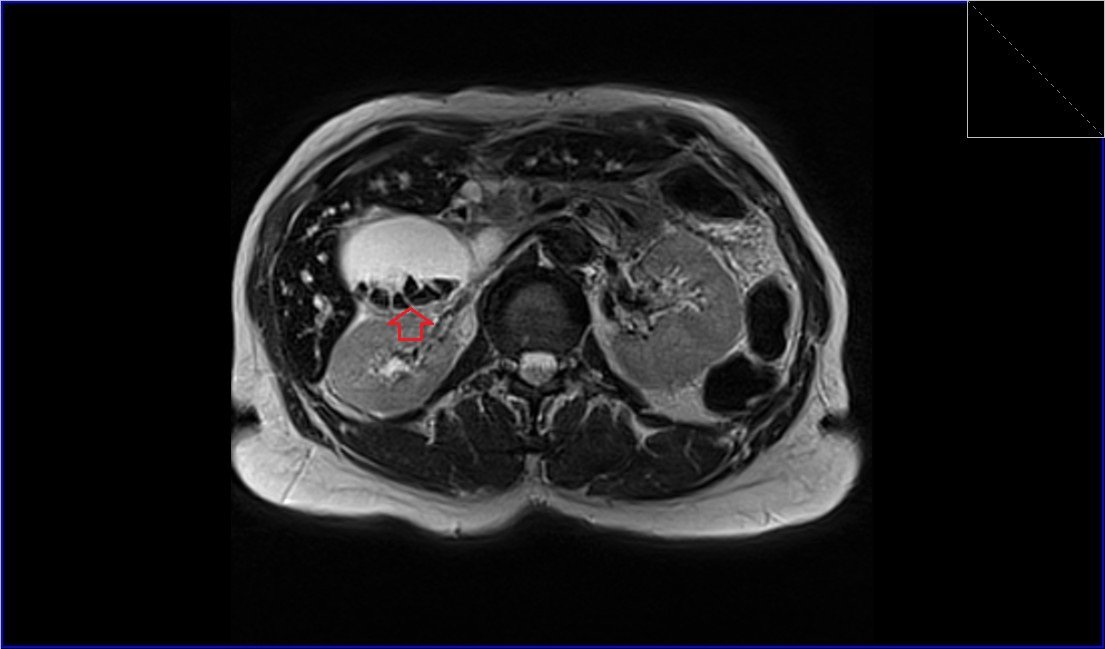 MRI T2 tse axial l image shows gallstones
