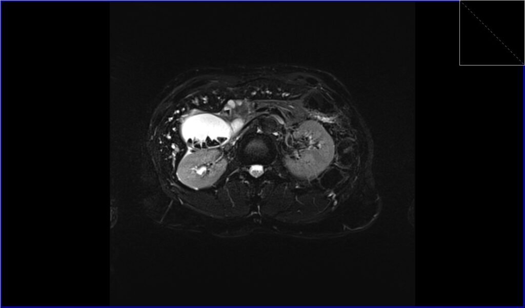 MRI T2 fat sat axial l image shows gallstones