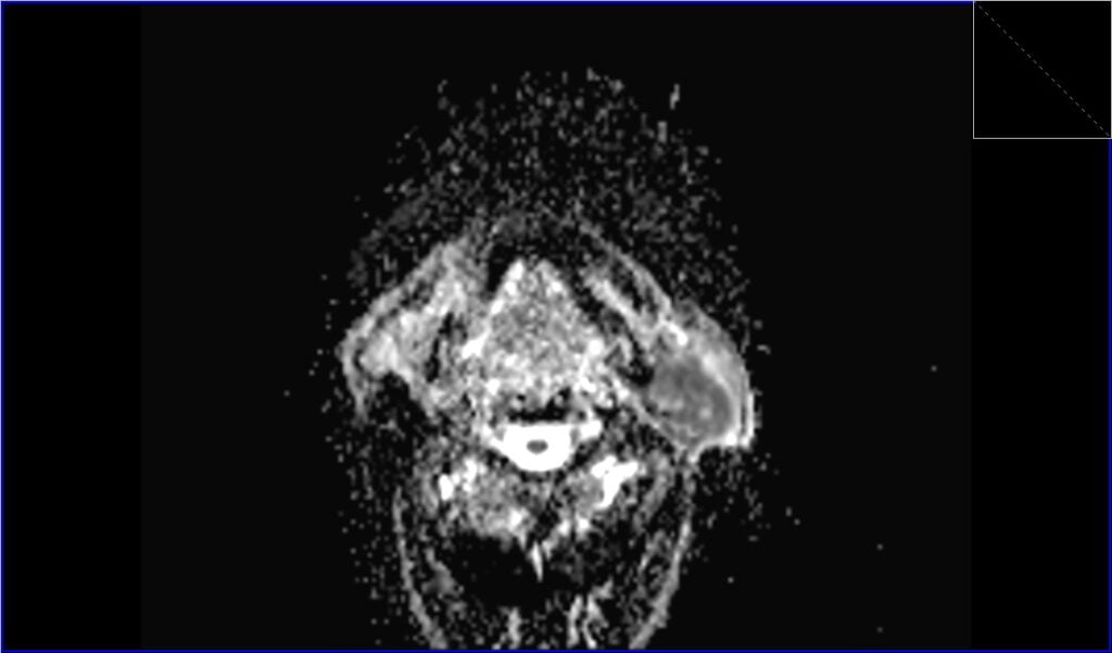 Warthin's tumor MRI