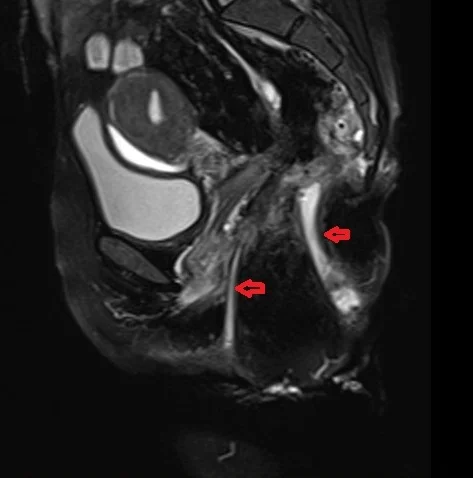 Anorectal Fistula MRI