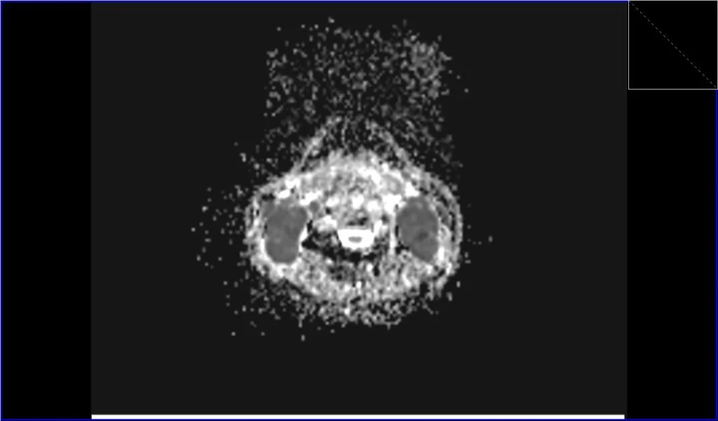 DWI axial ADC image shows neck Lymphoma