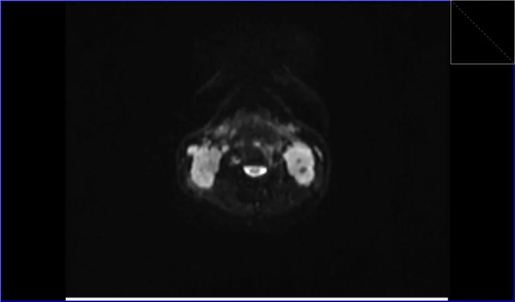 DWI axial b0 image shows neck Lymphoma