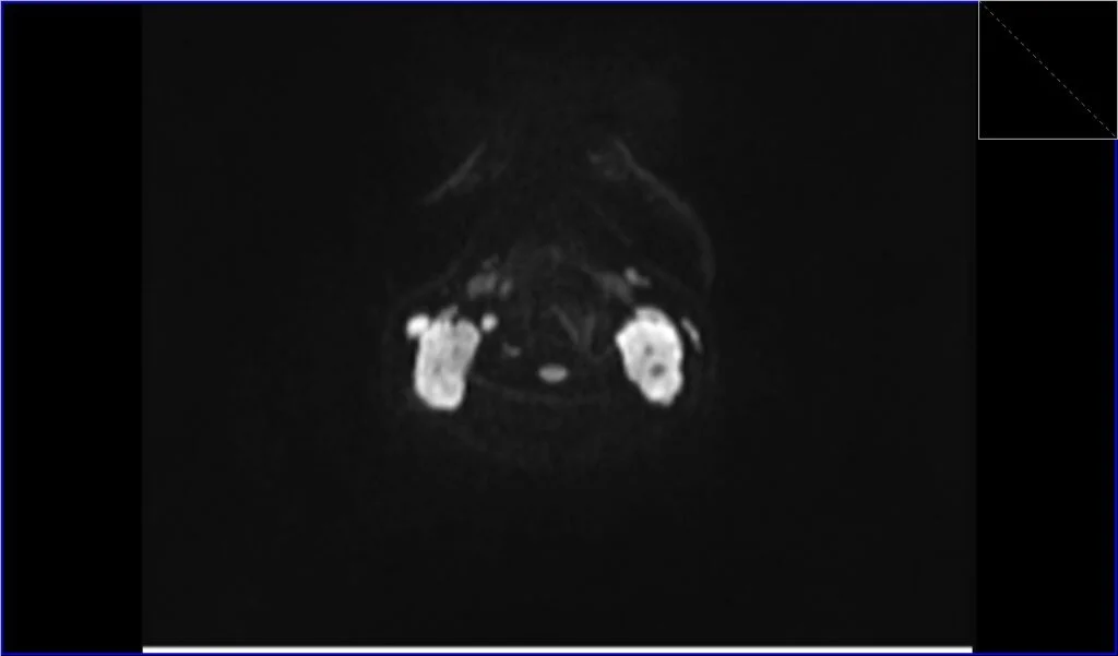 DWI axial b800 image shows neck Lymphoma