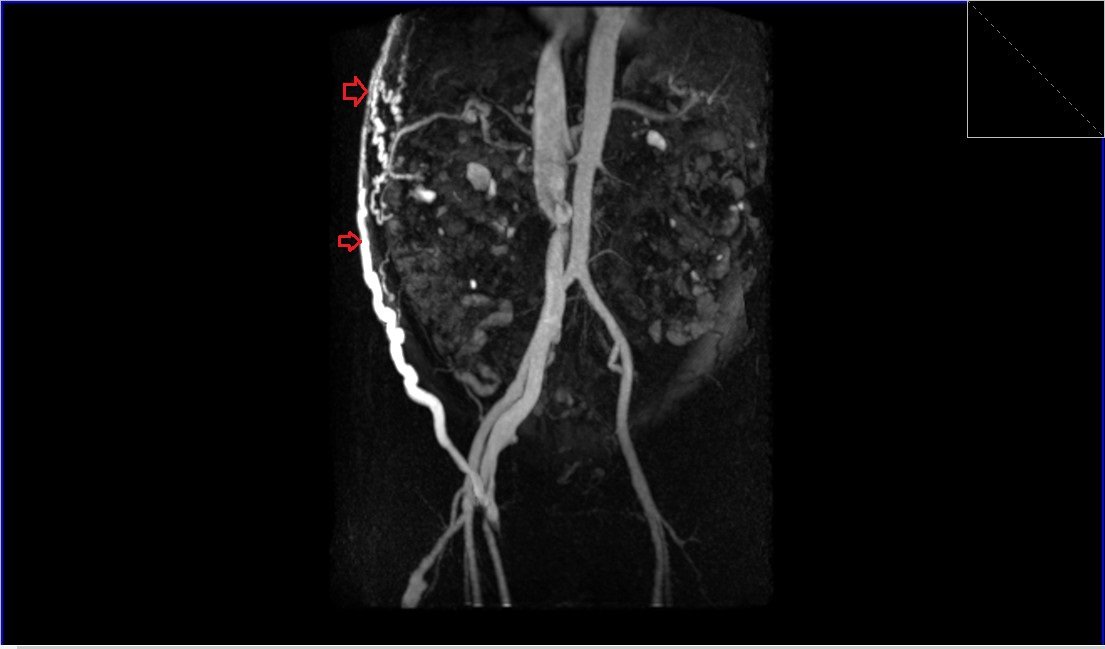 Abdominal Wall Arteriovenous Malformation (AVM) MRI