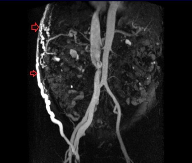 FLASH 3D MIP coronal image shows Abdominal Wall AVM