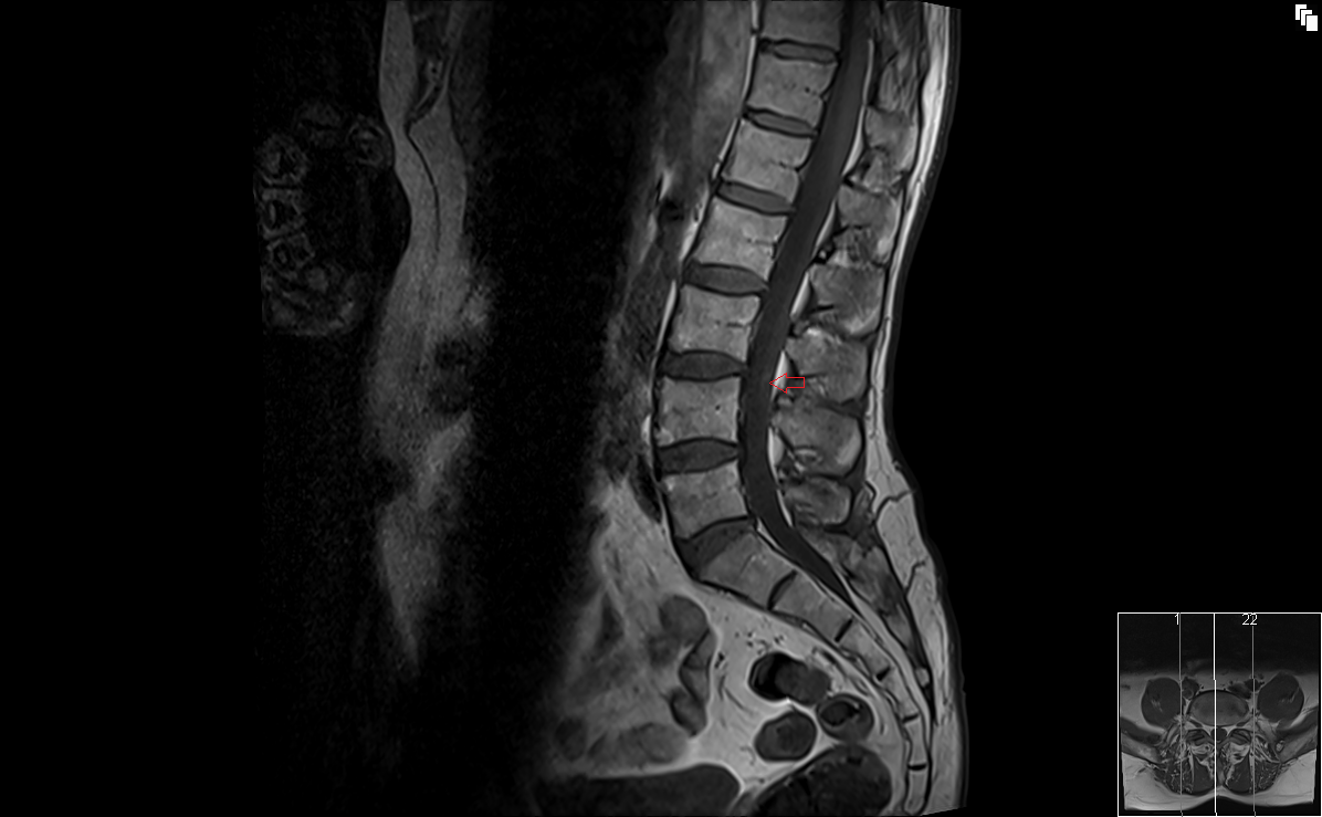 Neurofibroma MRI | Radiology article on neurofibroma