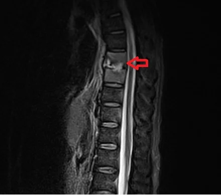 MRI discitis STIR image