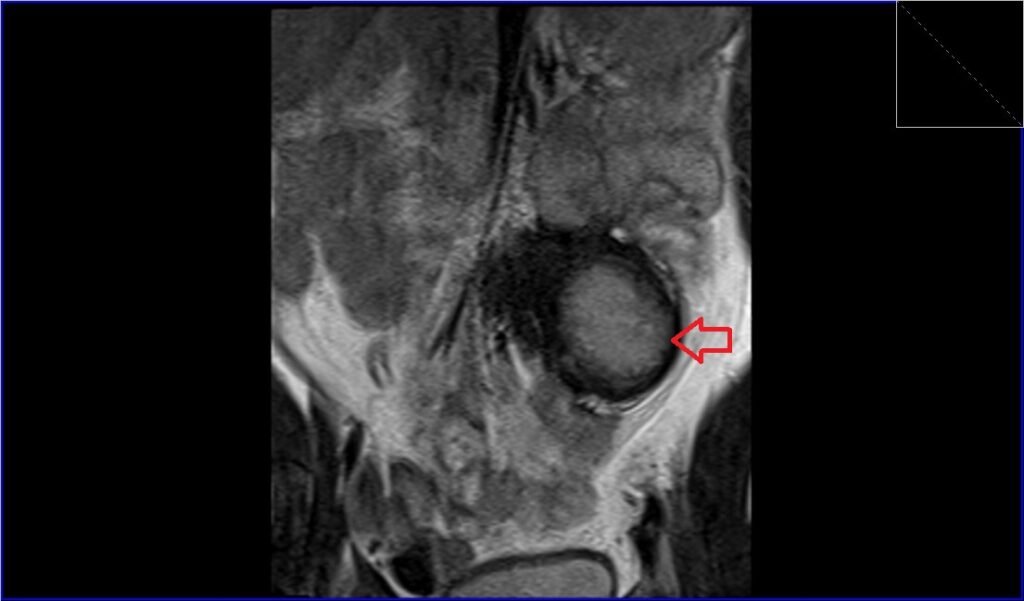 MRI retroperitoneal desmoid
