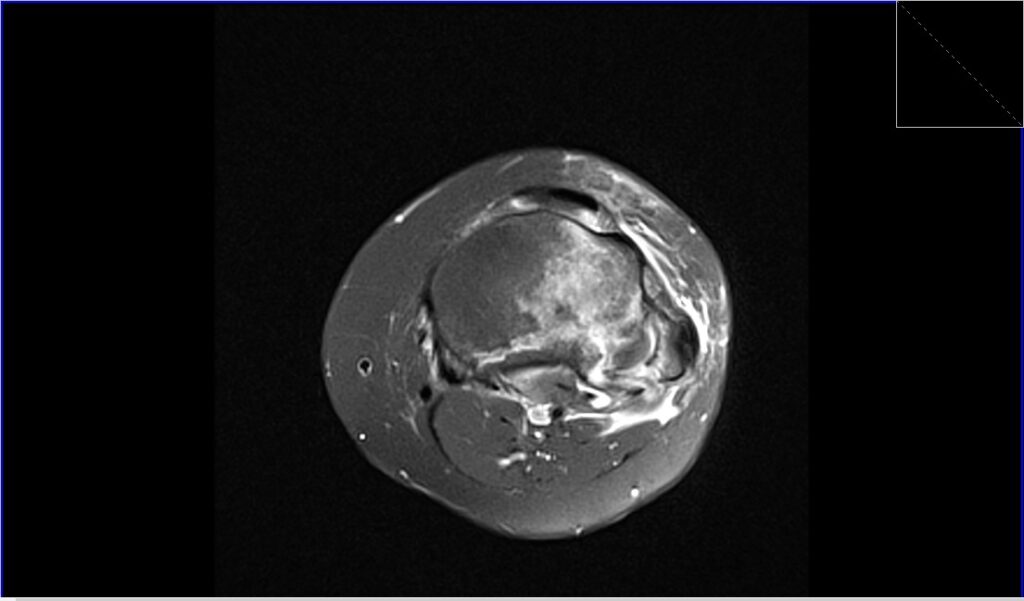 MRI Knee fractures | Radiology Article on Knee Fractures