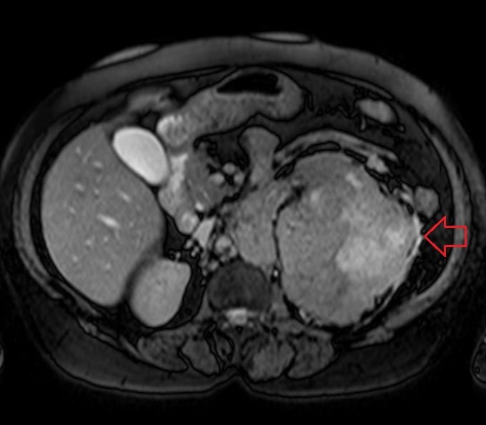 Renal cell carcinoma (RCC) MRI T2 image
