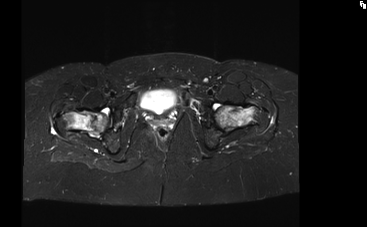 MRI Hip fractures | Radiology article on Hip fractures