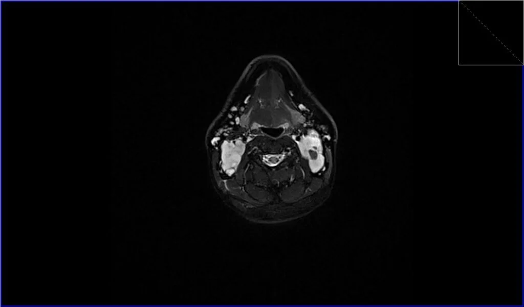 STIR axial image shows neck Lymphoma 1