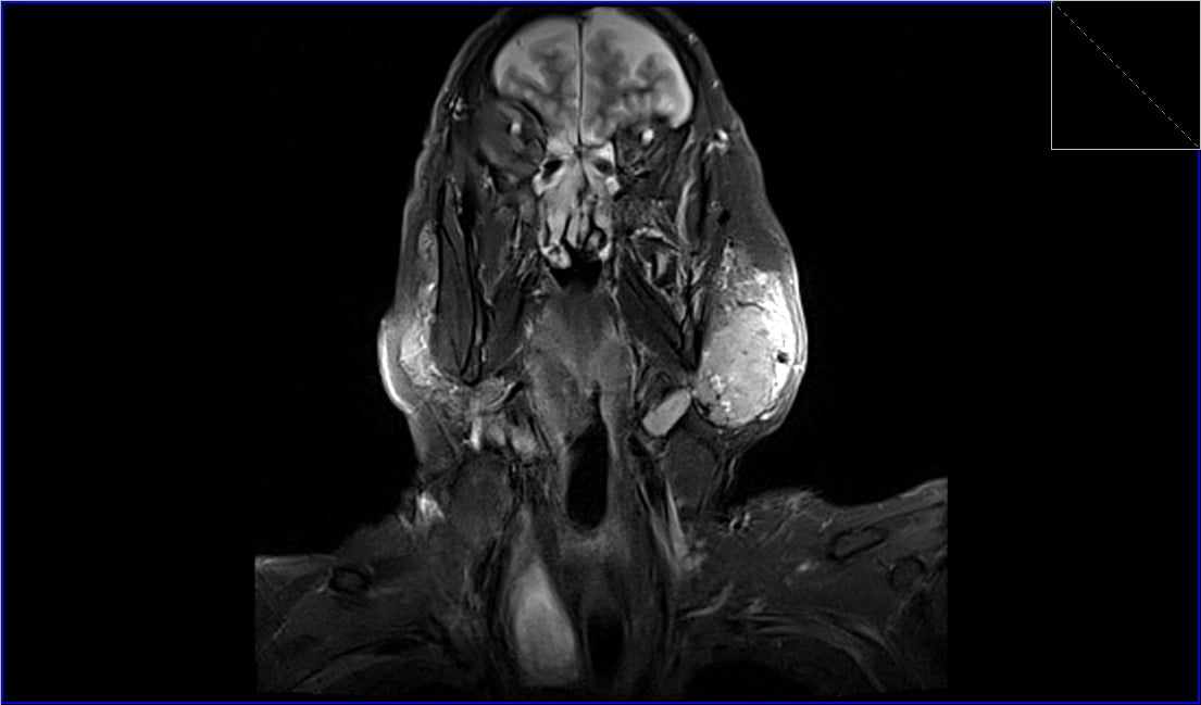 Warthin's tumor MRI