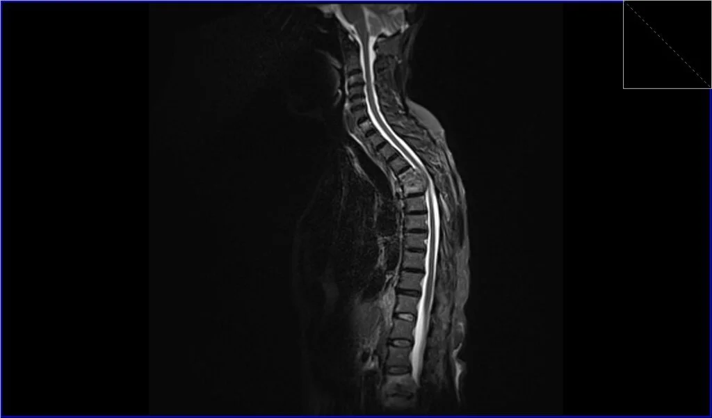 STIR sagittal image shows Metastatic Spinal Cord Compression