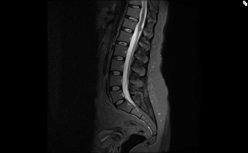 STIR sagittal image shows conus medullaris lipoma 1