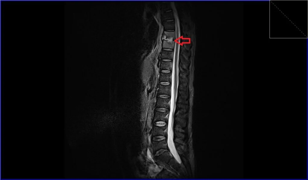 STIR sagittal image shows discitis