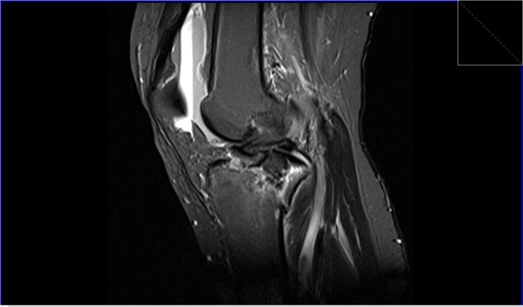 Mri Knee Fractures 