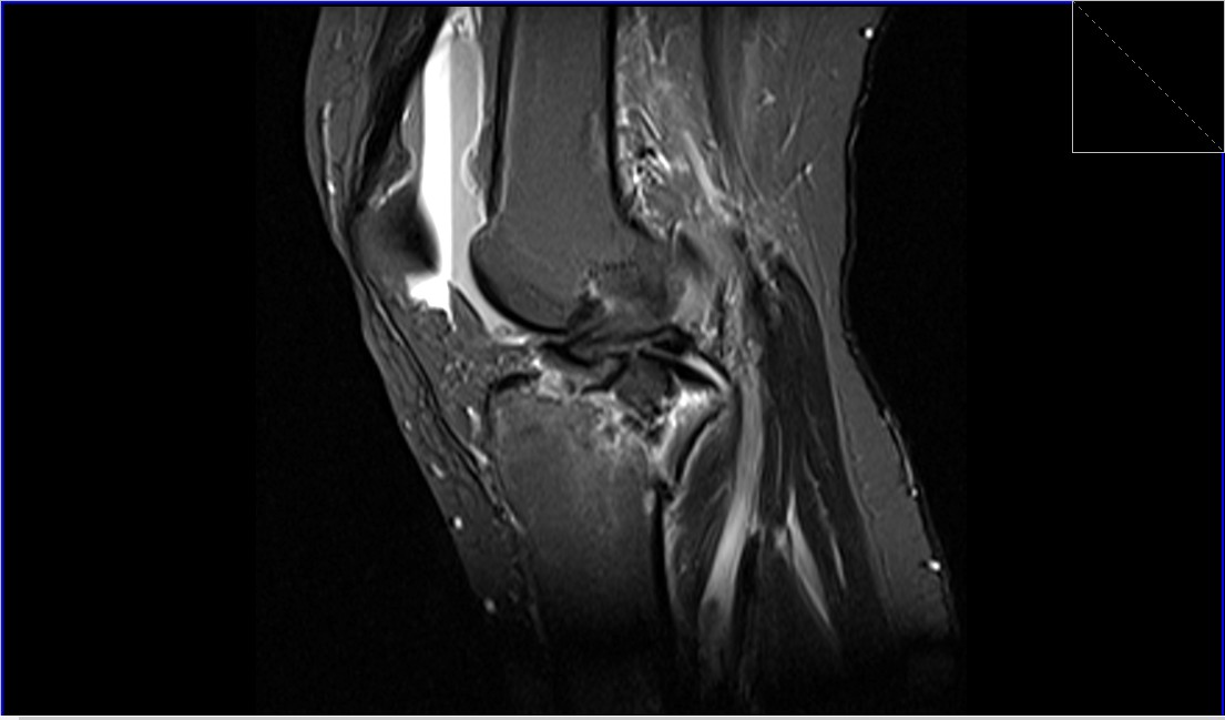 MRI Knee fractures | Radiology Article on Knee Fractures