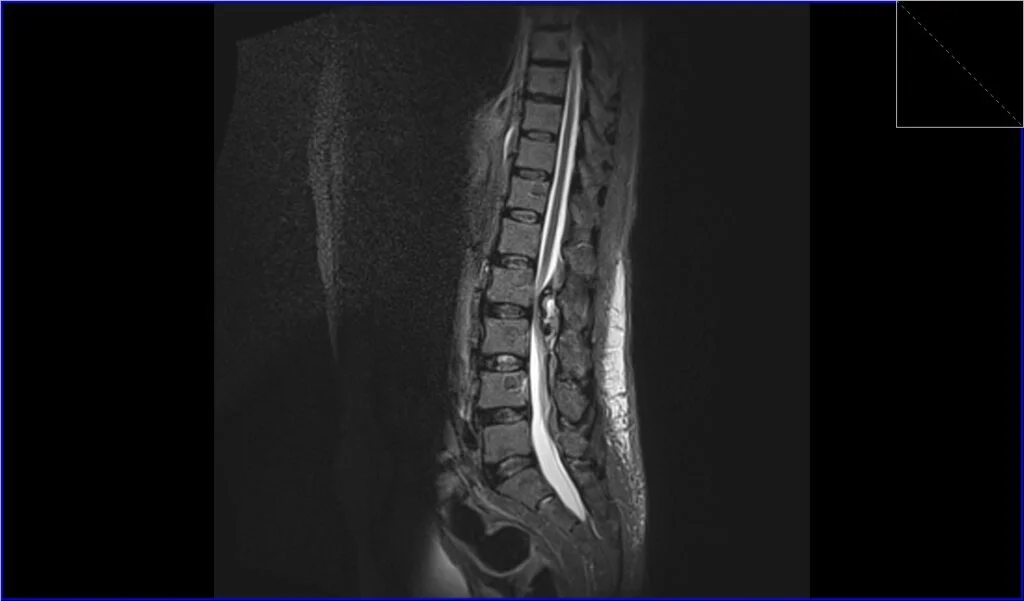 STIR sagittal image shows seroma
