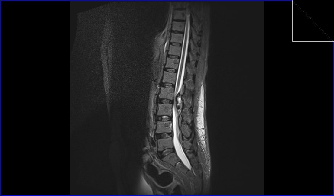 Spinal Seroma Mri Radiology Article On How To Report Seroma 6349