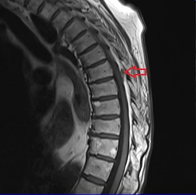 Spinal neurofibroma MRI