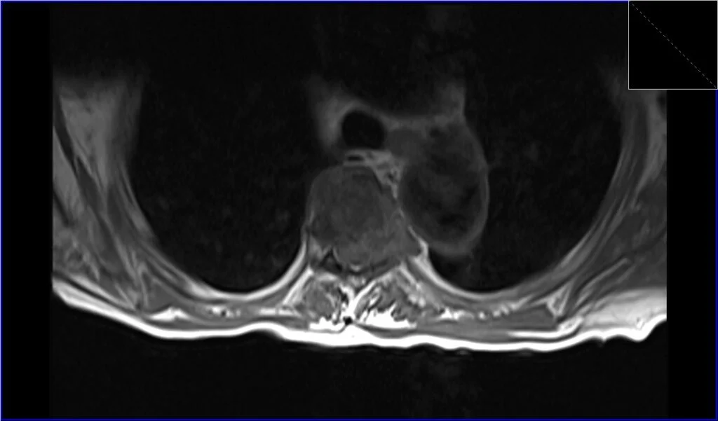 T1 TSE axial image shows Metastatic Spinal Cord Compression