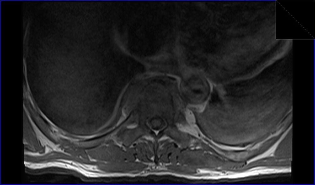 T1 TSE axial image shows discitis