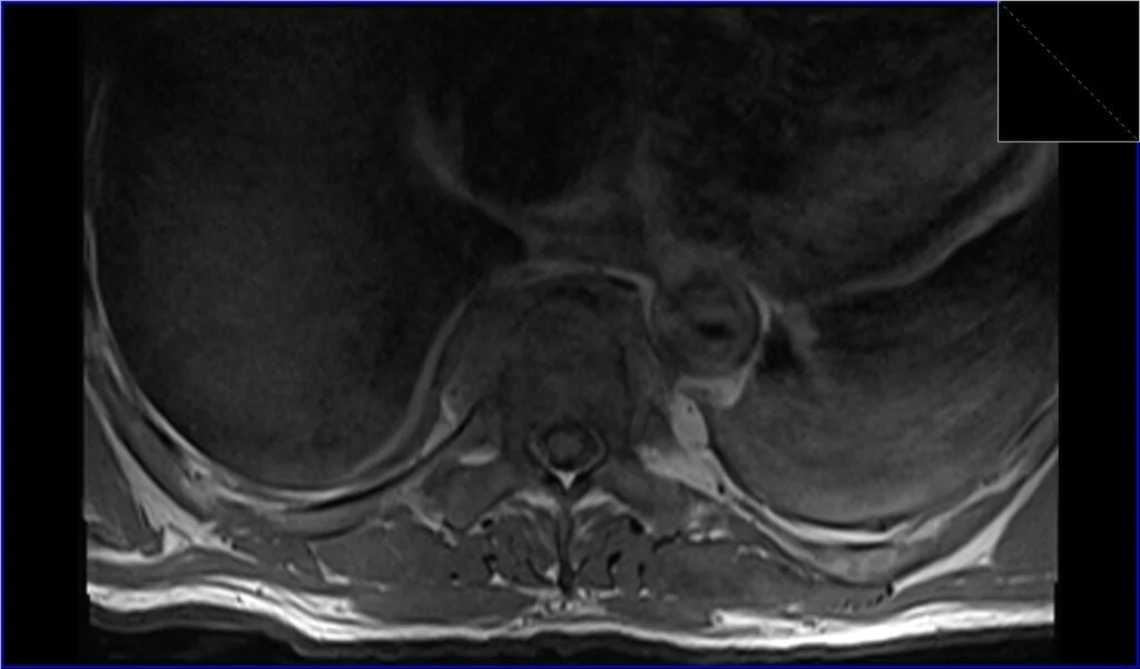 T1 TSE axial image shows discitis
