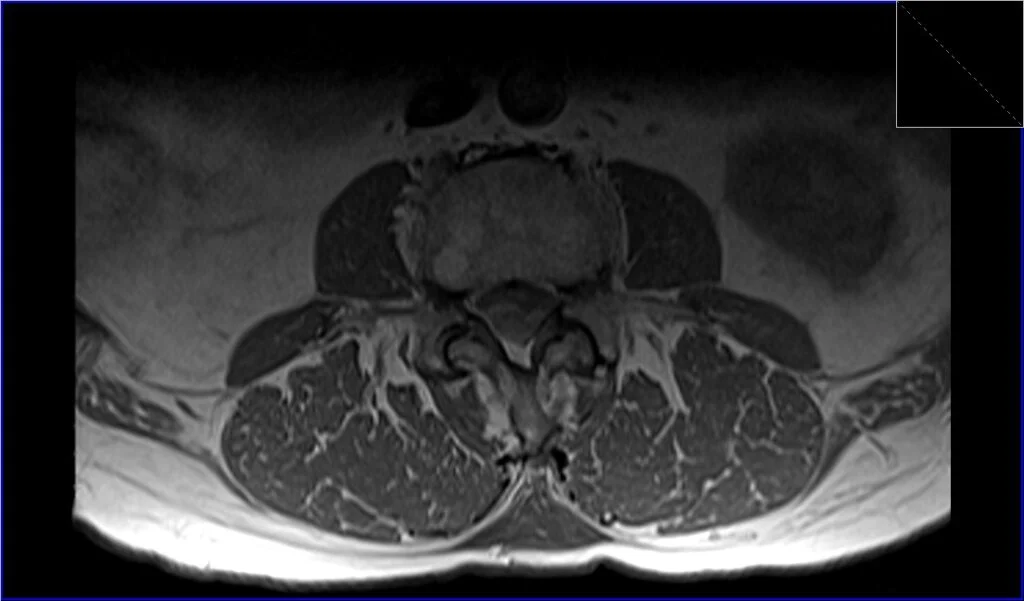 T1 TSE axial image shows seroma