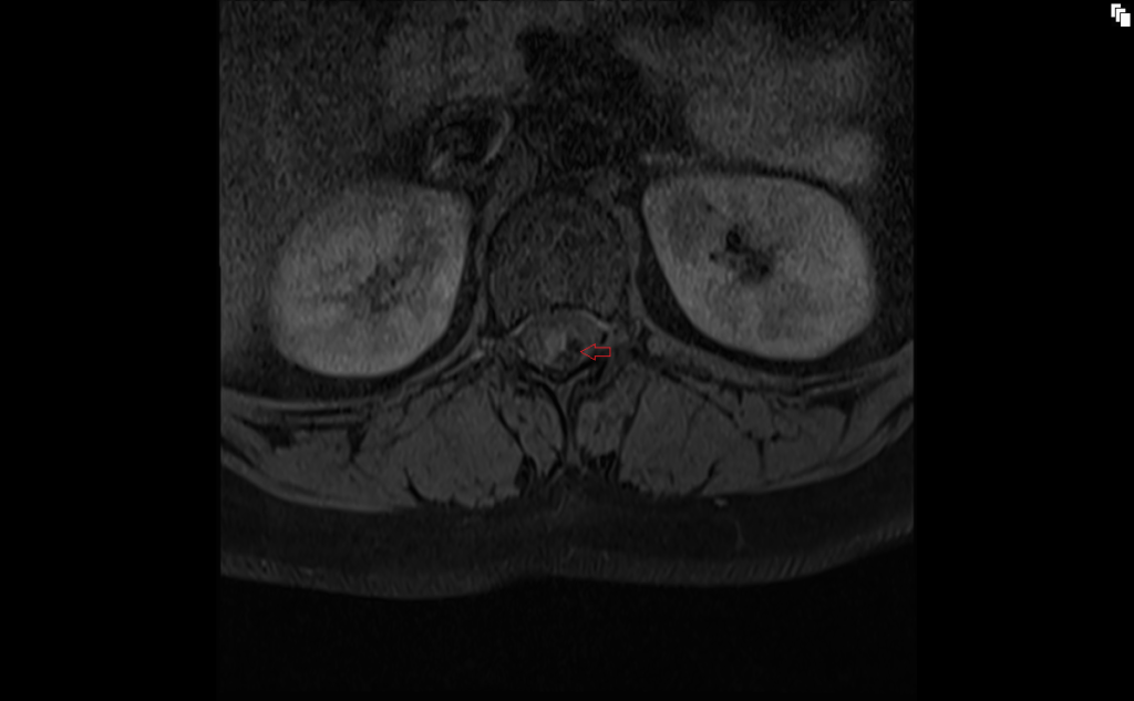 T1 TSE fat sat axial image shows conus medullaris lipoma