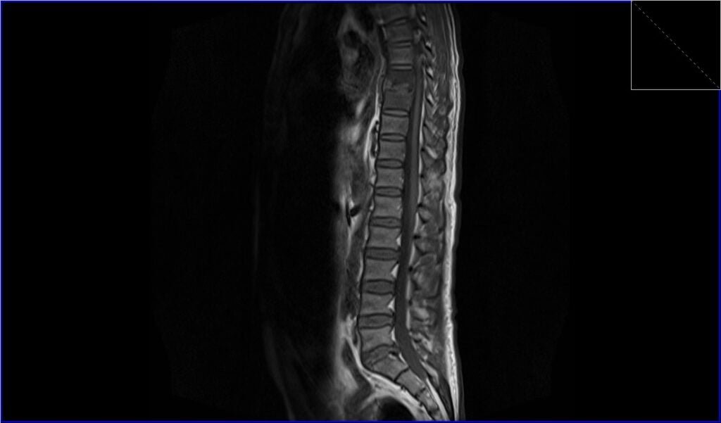 T1 TSE sagittal image shows discitis