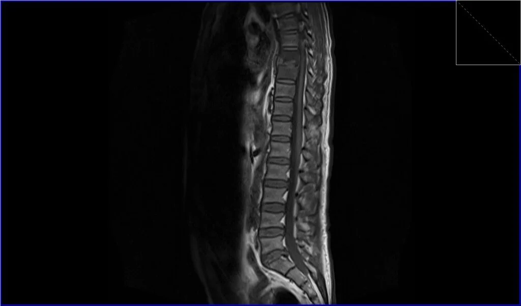 T1 TSE sagittal image shows discitis