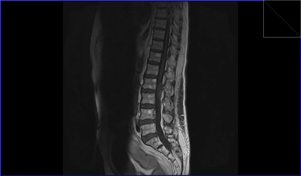 T1 TSE sagittal image shows seroma